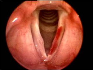 blood in Mouth